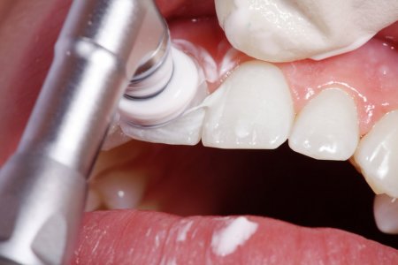 Чистка зубов у стоматолога