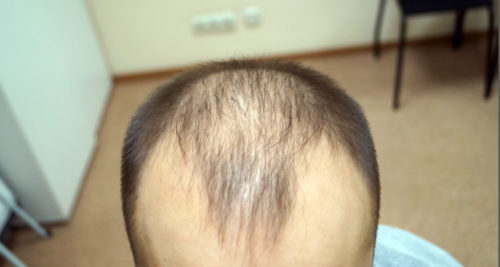 Где сделать FUE-пересадку волос