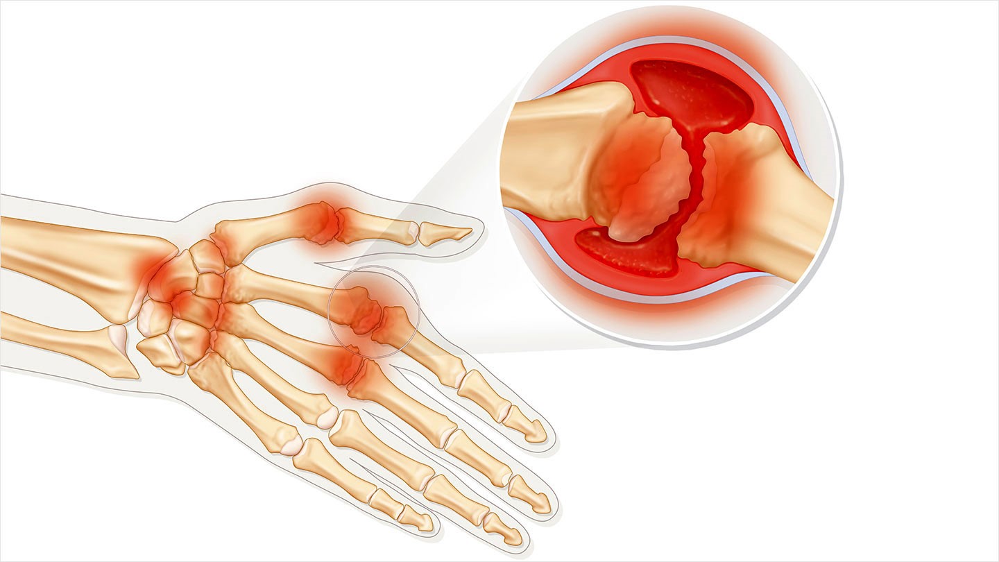 Ревматизм костей и суставов. Ревматоидный артрит суставы. Ревматоидный артрит сустава запястья.