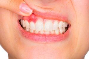 Как правильно лечить воспаленные десны?