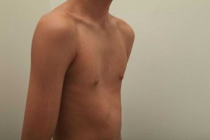 Почему возникает воронкообразная деформация грудной клетки: причины и симптомы