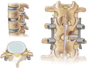Операция при переломе позвоночника: показания, методы и восстановление