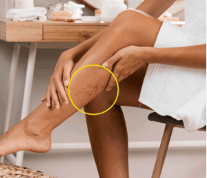 Как флебология помогает поддерживать здоровье вен: современные методы и профилактика