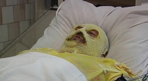 Боец ВСУ, получивший под Дебальцево ожоги 80% тела пообещал вернуться в зону "АТО"